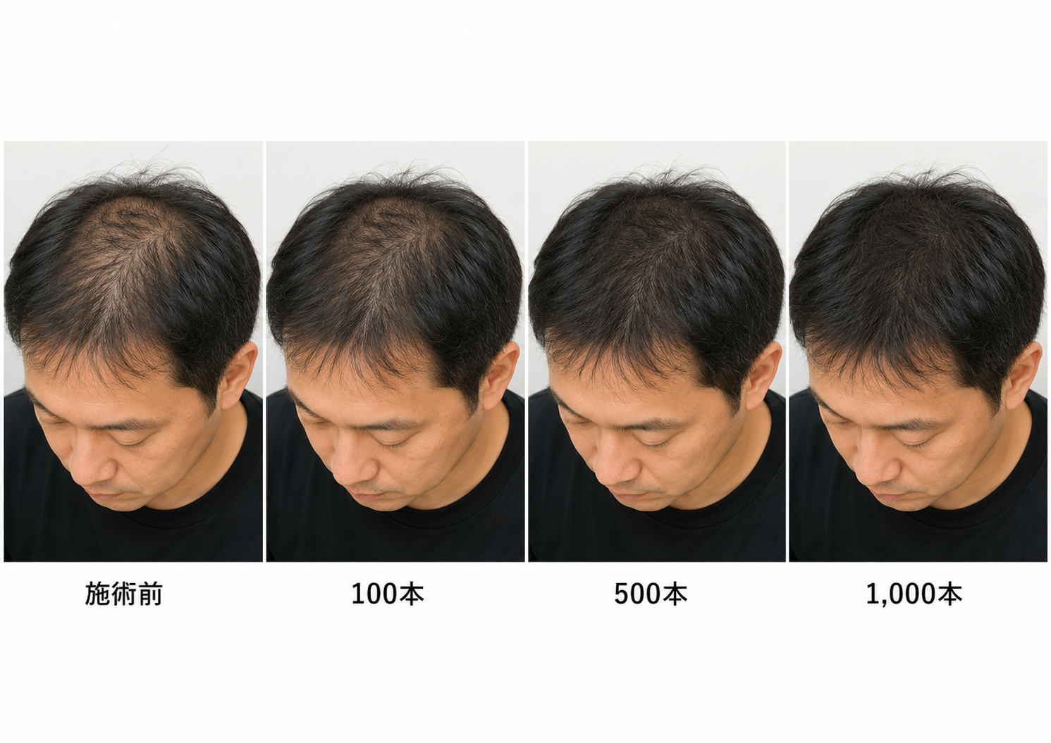 増毛100本・500本・1,000本の見た目の変化イメージ。本数が増えるほど地肌の見え方が変わる